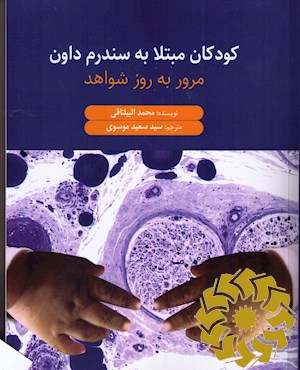 کودکان مبتلا به سندرم داون